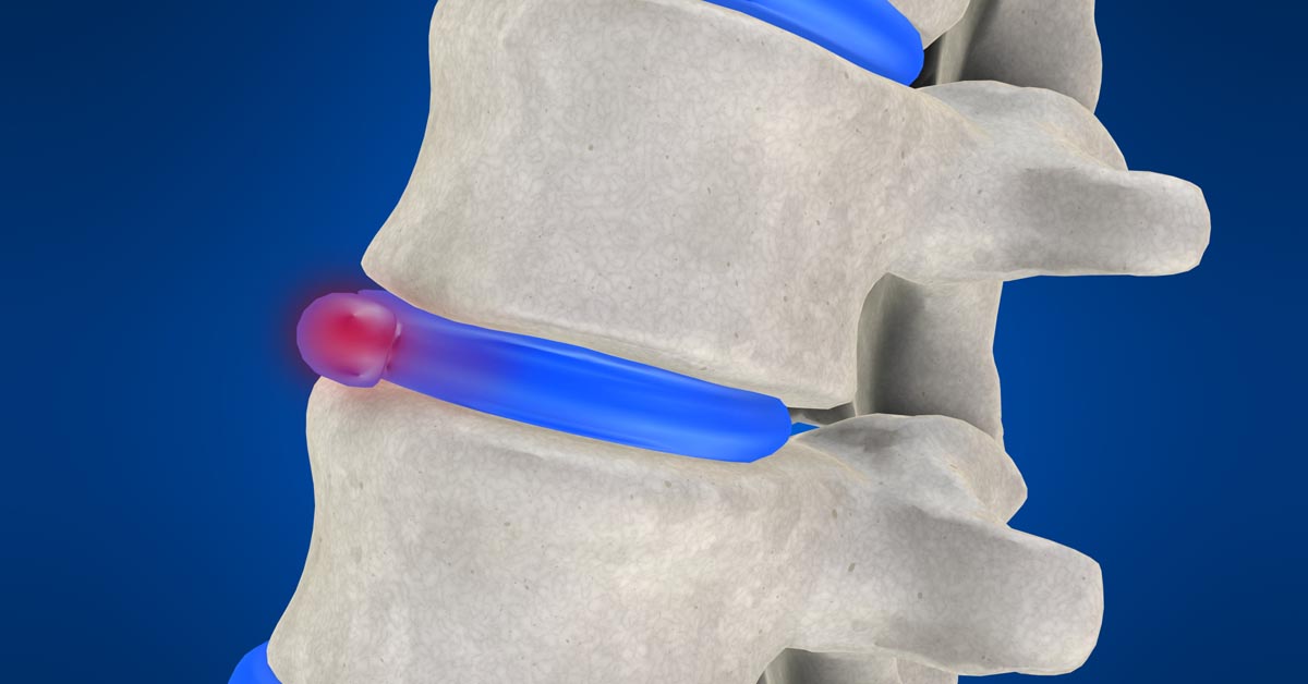 Lincoln non-surgical disc herniation treatment